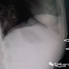 The lateral X-ray image indicates signs of the protrusion of the costal arch (A and B) and depression of chest wall (C)