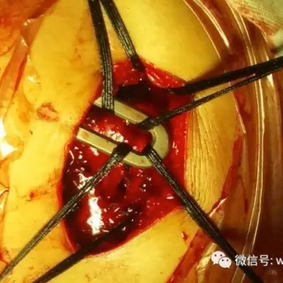 Intraoperative guidance and fixation of the bars