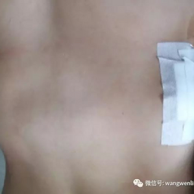 The chest wall appearance after the surgery