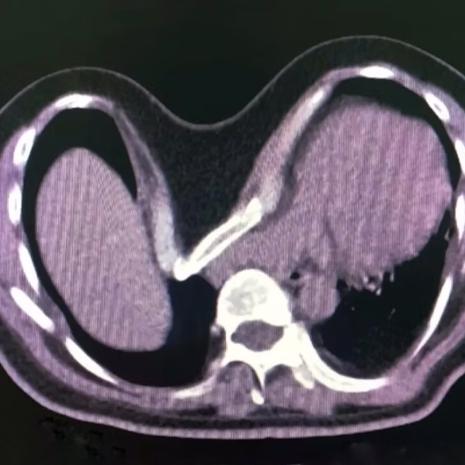 What is Pectus Excavatum?