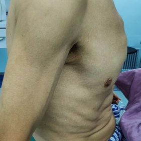 The anterior chest wall protrudes prominently