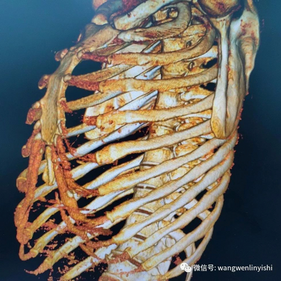 The 3D reconstruction shows a prominent protrusion in the central part of the anterior chest wall