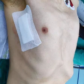 The chest wall deformity was corrected after the surgery