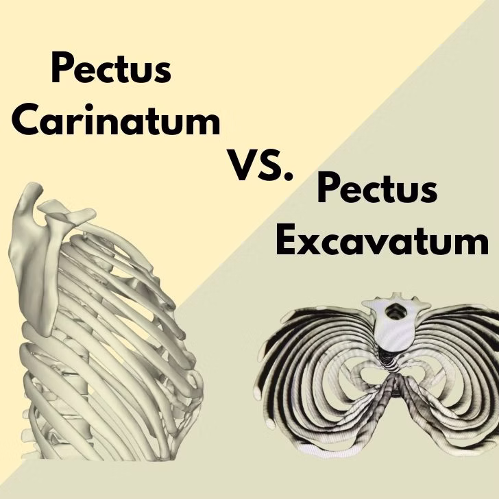 Pectus Excavatum vs. Pectus Carinatum: Key Differences