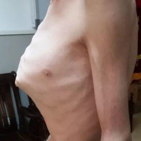 The most severe part is at the xiphoid process