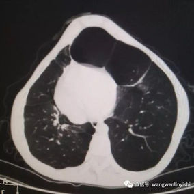 Two large cysts can be seen in the lower lobe of the left lung, located between the heart and the anterior chest wall