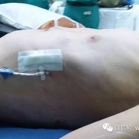 The deformity was eliminated after the surgery, and the chest wall was restored to normal