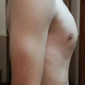 There is a large area of severe protrusion on the anterior chest wall