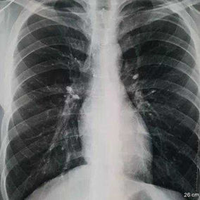 No obvious abnormalities can be seen in the chest wall, but the sternum fixation wires are visible