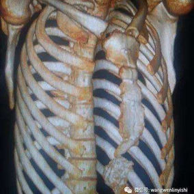 The preoperative 3D Reconstruction shows a protruding sternum with a depression at the lower portion of the chest wall