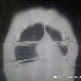 The postoperative CT scan shows the position of the bars