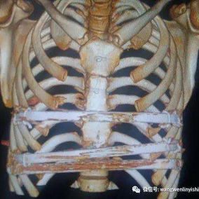 The postoperative 3D reconstruction shows the positions of the bars