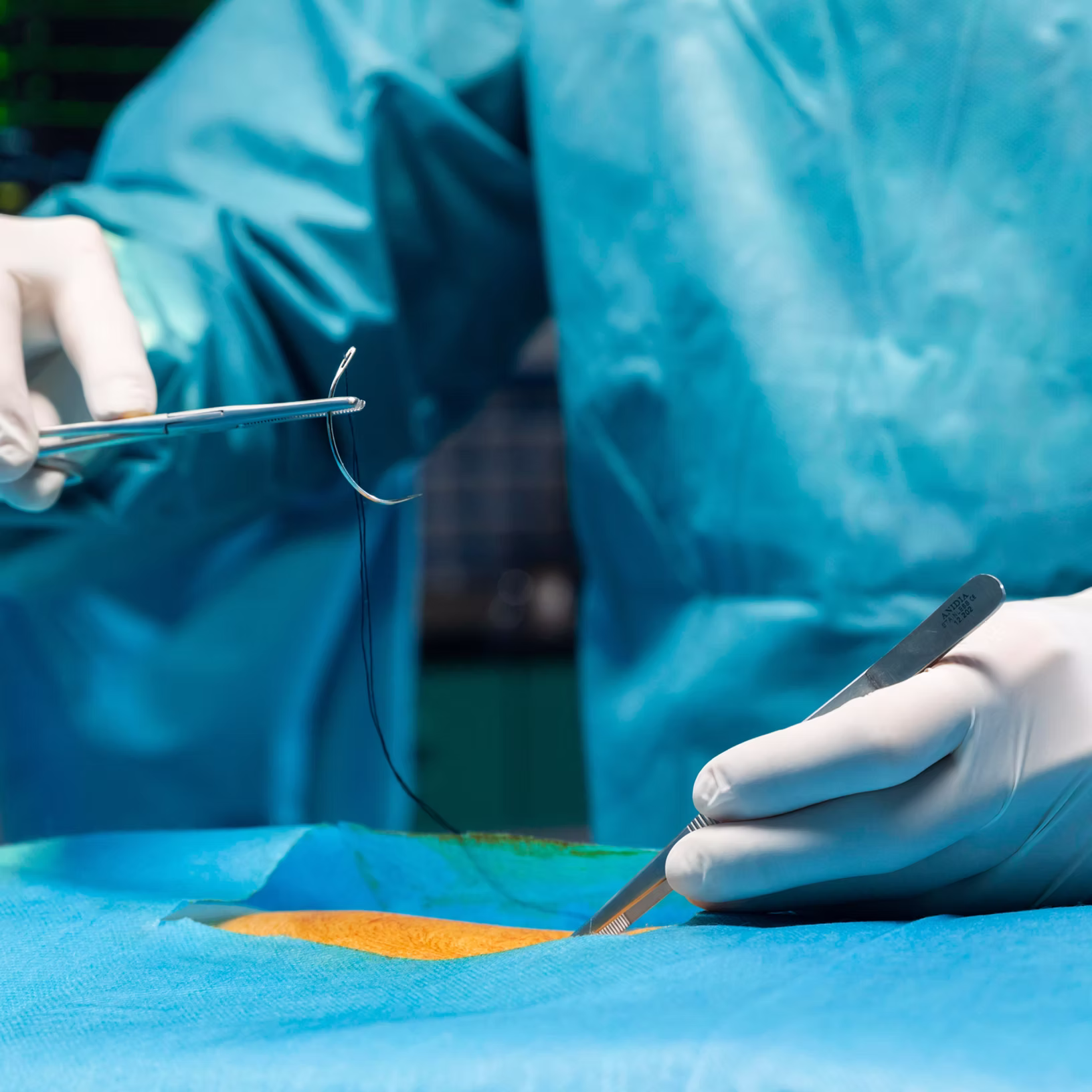After Chest Wall Surgery: Understanding Your Incisions and Infection Risks