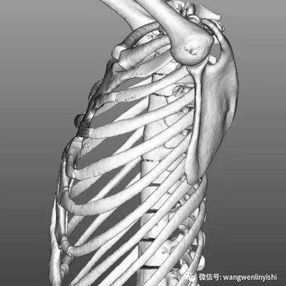 In this case of flatback syndrome, the thoracic spine shows a slight forward protrusion