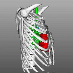 Due to the loss of the physiological curvature of thoracic spine , the heart, major blood vessels, and trachea are confined to a narrow space behind the sternum