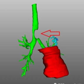 Significant tracheal compression is observed, along with localized defects