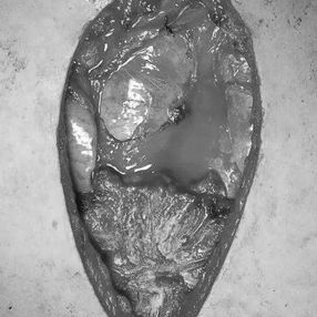 An incision was made at the pericardial reflection adjacent to the ascending aorta, thereby exposing it