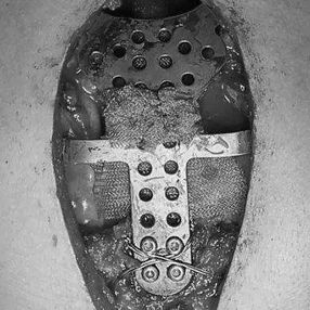 The anterior chest wall was reconstructed using digital material, and the sling around the ascending aorta was tightened