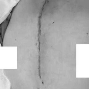 Drainage tubes were indwelt in each sides of the chest wall and at the surgical site following the surgery