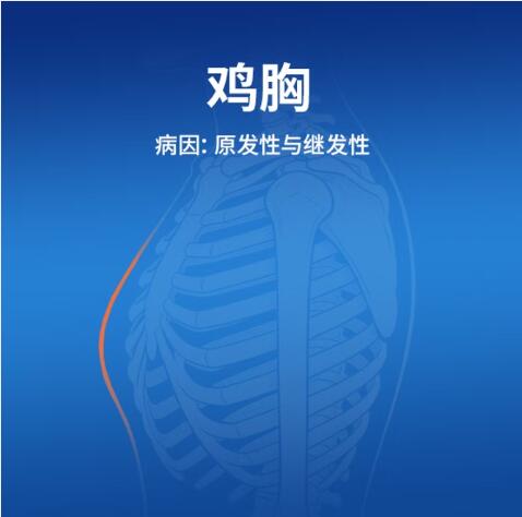 了解鸡胸的成因：原发性与继发性