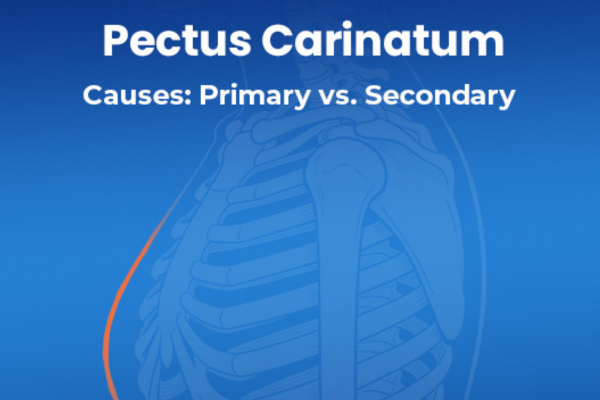 pectus carinatum causes