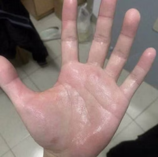 pamlar hyperhidrosis