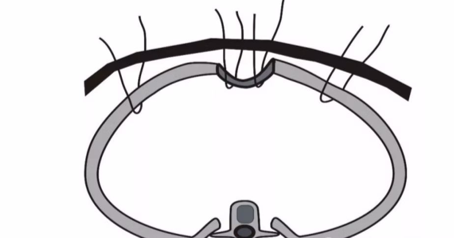 Flat Pectus Carinatum Surgery Illustration